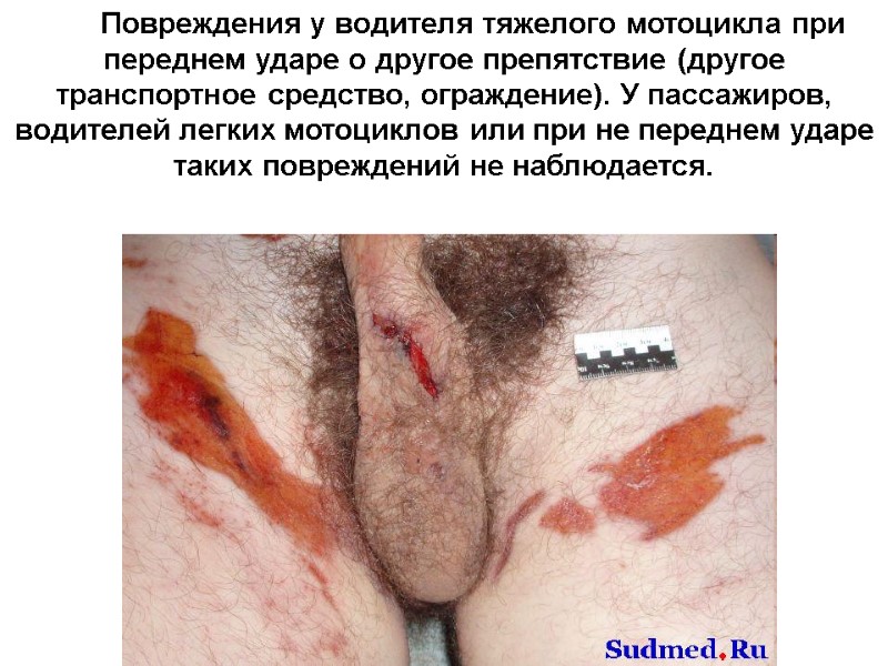 Повреждения у водителя тяжелого мотоцикла при переднем ударе о другое препятствие (другое транспортное средство,